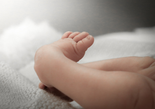 341. Clubfoot - Congenital Talipes Equinovarus (CTE)