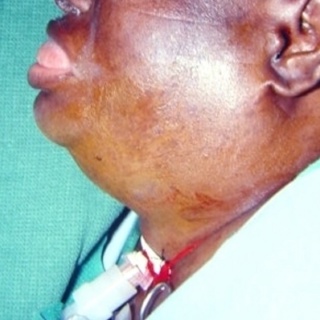 Jaw Infections