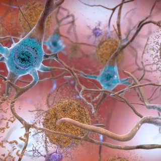 Därför splittras forskarna om de nya medicinerna mot alzheimer i Sverige