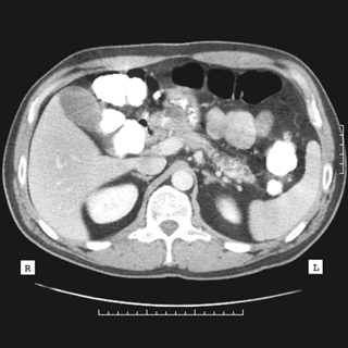 Managing Acute Pancreatitis