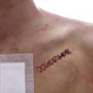 Ett hjärta som skenar