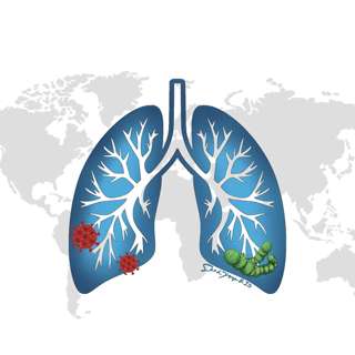 When a Cough Becomes a Killer: What Everyone Needs to Know About Pneumonia