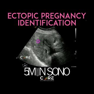 Point-of-Care Ultrasound for Ectopic Pregnancy Identification (5MS)