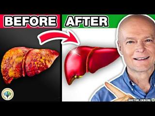 #1 Absolute Best FATTY LIVER DETOX 