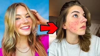 Acne Is Ruining My Life!