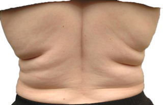Podcast #192: Back Fat Hernia