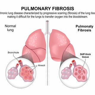 Signals in the Scars: The Search for New Ways to Predict and Treat Lung Fibrosis