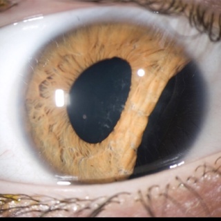 Eye Injuries