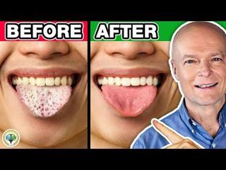 #1 Absolute Best Way To Cure Yeast & Candida Overgrowth 