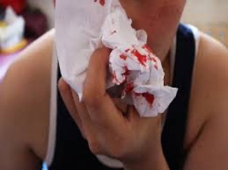 Podcast 536: Epistaxis 101