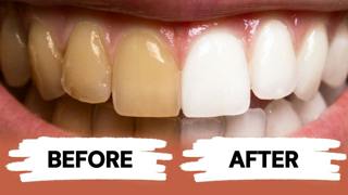 Teeth Whitening at Home 