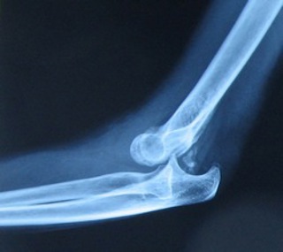 Podcast #317: Elbow Dislocation
