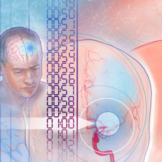 Highlights From the International Stroke Conference