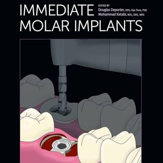 Immediate Molar Implants
