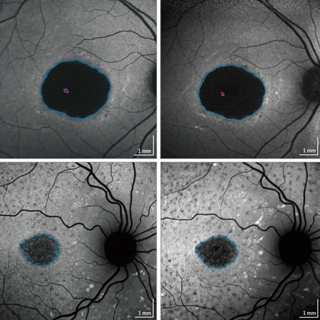 Progression of Stargardt Disease as Determined by Fundus Autofluorescence Over a 12-Month Period