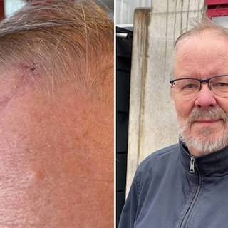Markus fick sin demenssjukdom bortopererad (R)