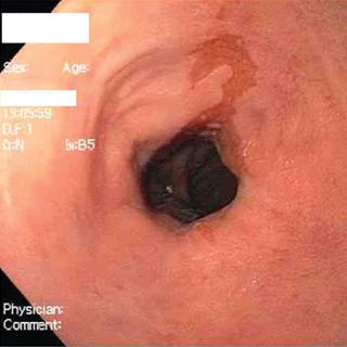 GERD and Esophagitis