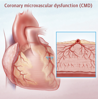 The Underappreciated Problem of Cardiac Disease in Women
