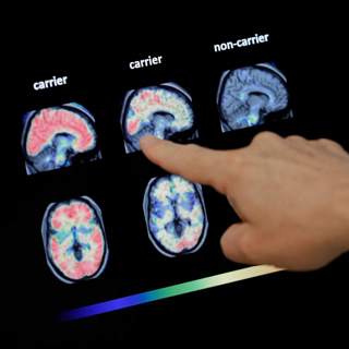 How your bank account might predict dementia
