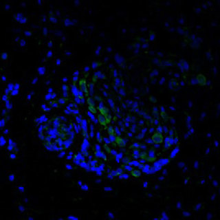 Ocular Histopathologic Features of Congenital Zika Syndrome