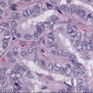 Surveillance for Thyroid Cancer