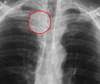 Podcast 763: Sternoclavicular Infection