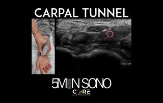 5 Minute Sono - Carpal Tunnel Exam