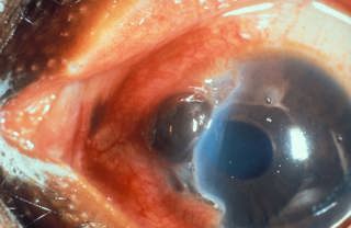 424. Ocular Trauma 2: Intraocular Foreign Bodies and Globe Rupture