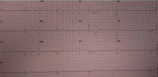 Podcast 694: Complete Heart Block