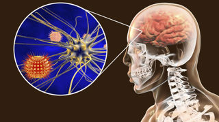 COVID-19 Digest: Neurological Manifestations of COVID-19