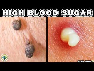 10 Alarming Skin Signs of Diabetes 