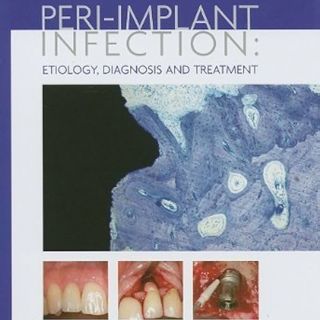 Peri-implant Infection Etiology: Diagnosis and Treatment