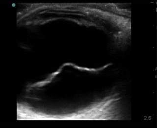 Podcast #446: Retinal Detachment