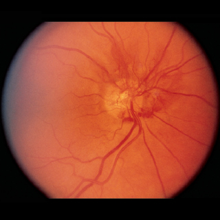 Multicenter Evaluation of Diagnostic Circulating Biomarkers to Detect Sight-Threatening Diabetic Retinopathy