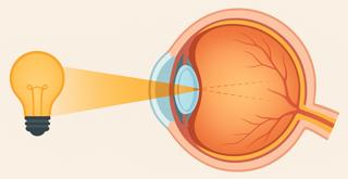 434. Refractive Errors, Eye Optics & Vision Correction Options