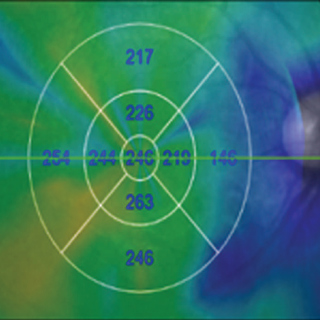 Association of Secondhand Smoking Exposure With Choroidal Thinning in Children Aged 6 to 8 Years