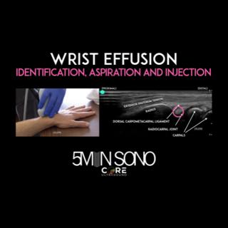 Wrist Effusion - Identification, Aspiration and Injection