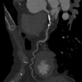 Is coronary artery calcification good or bad?