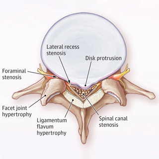 Lumbar Spinal Stenosis: A Review