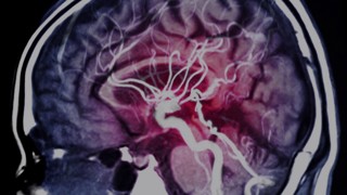 COVID-19 Digest: Strokes in Young People with COVID