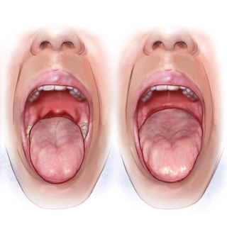 Treating Obstructive Sleep Apnea