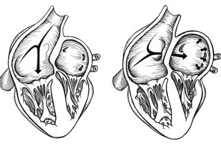 Podcast #248: Patent Foramen Ovale