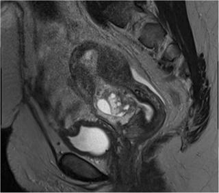 Podcast 565: Cesarean Scar Pregnancies