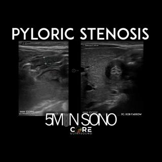 5 Minute Sono - Pyloric Stenosis