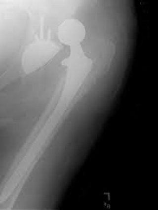 Podcast 652: Prosthetic Hip Dislocation
