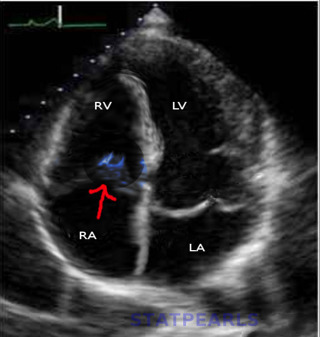Podcast 762: Endocarditis