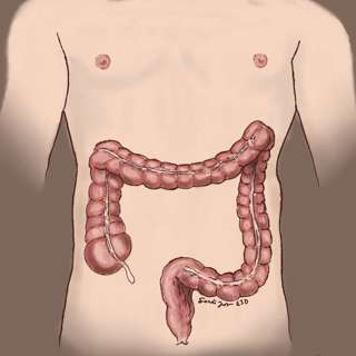 The New Face of Colorectal Cancer: Celebrity Legacies, the Screening Gap and How to Advocate for Yourself