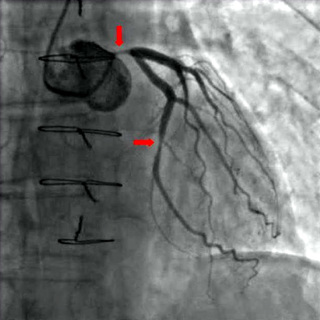 Podcast 564: Cardiac Ischemia Management Update