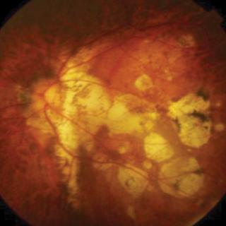 Axial Length and Risk of Uncorrectable Visual Impairment for Myopia