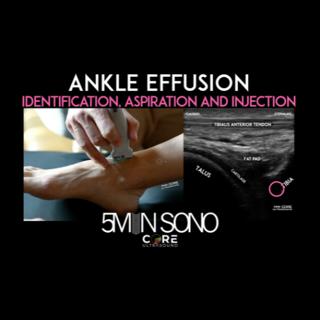 Ankle Effusion - Identification, Aspiration and Injection